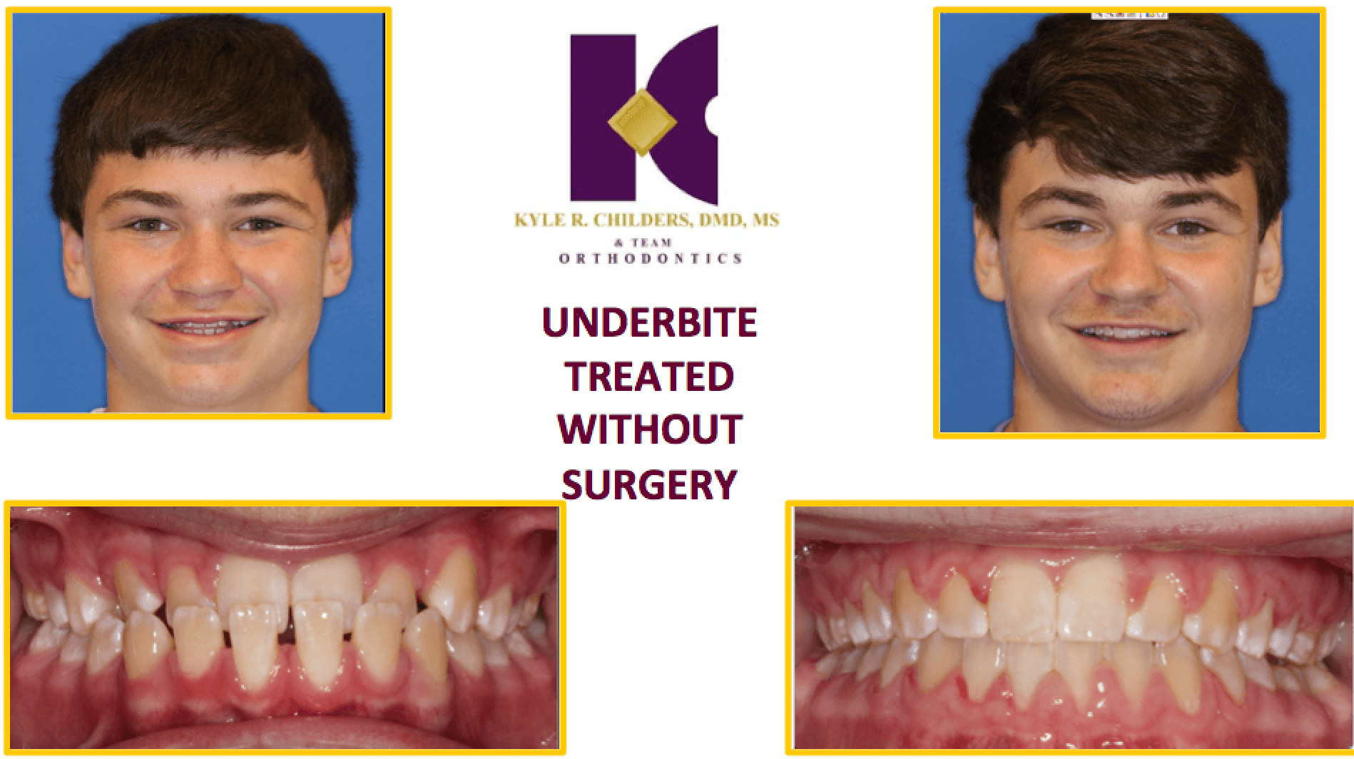 A picture of a boy 's teeth with the words underbite treated without surgery