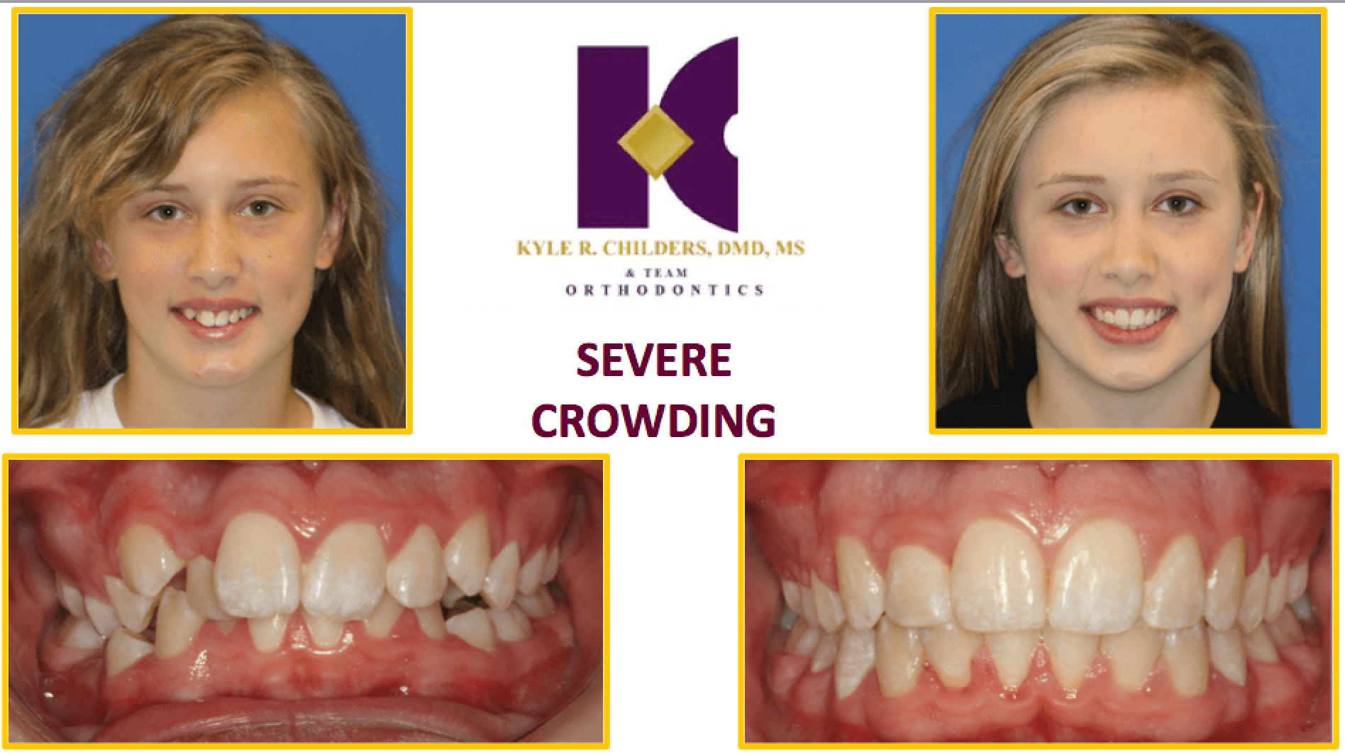 A picture of a girl with severe crowding on her teeth