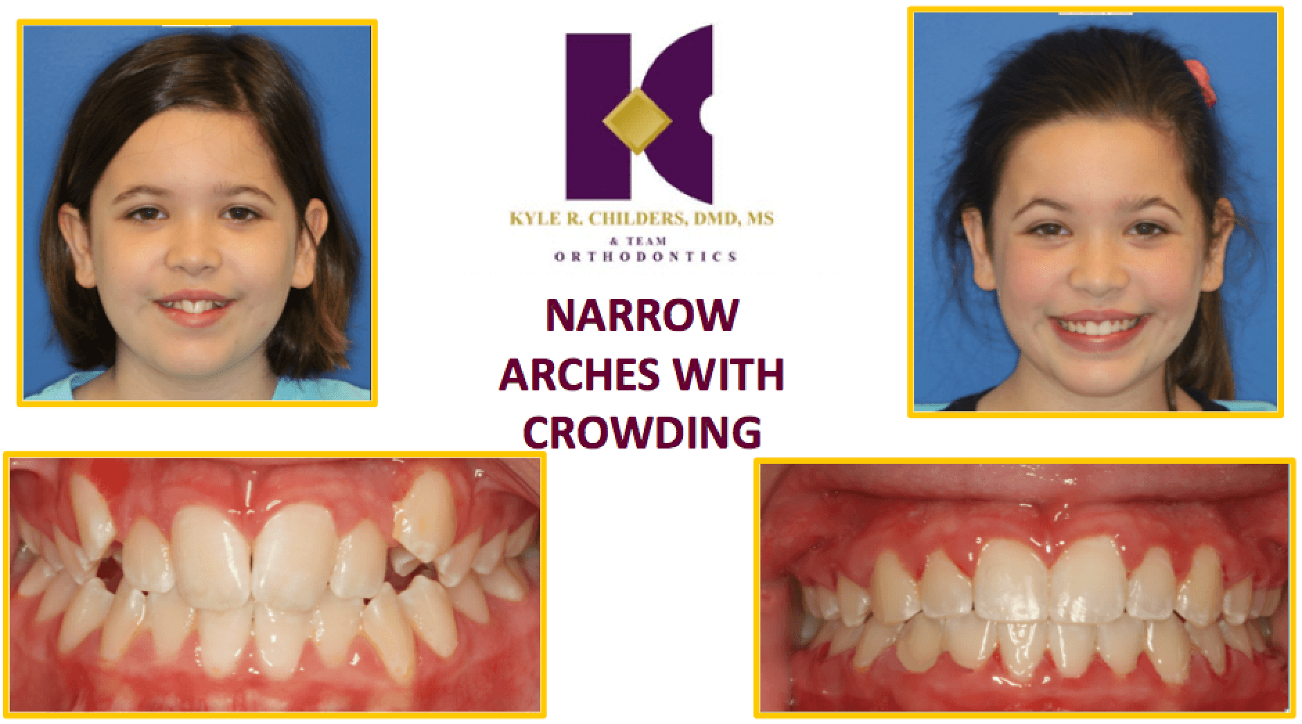 A picture of a girl with narrow arches with crowding