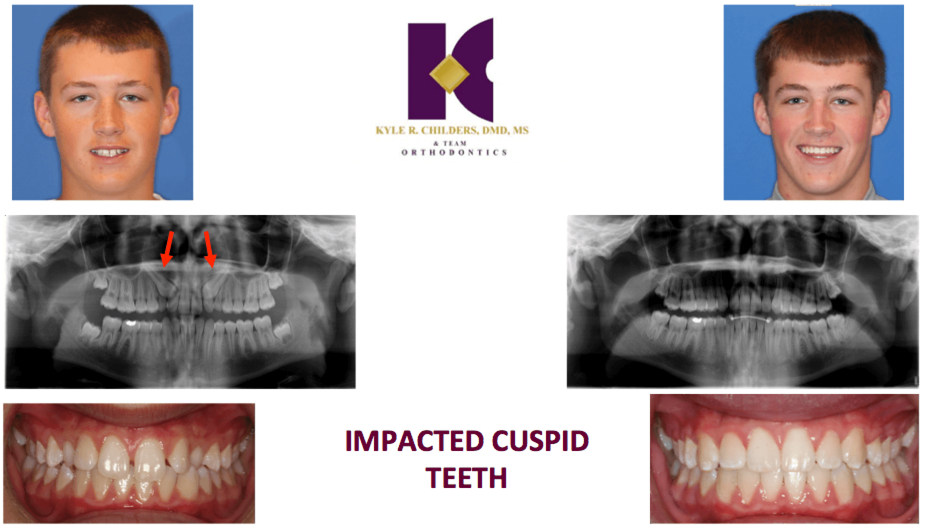 A picture of a boy with impacted cuspid teeth