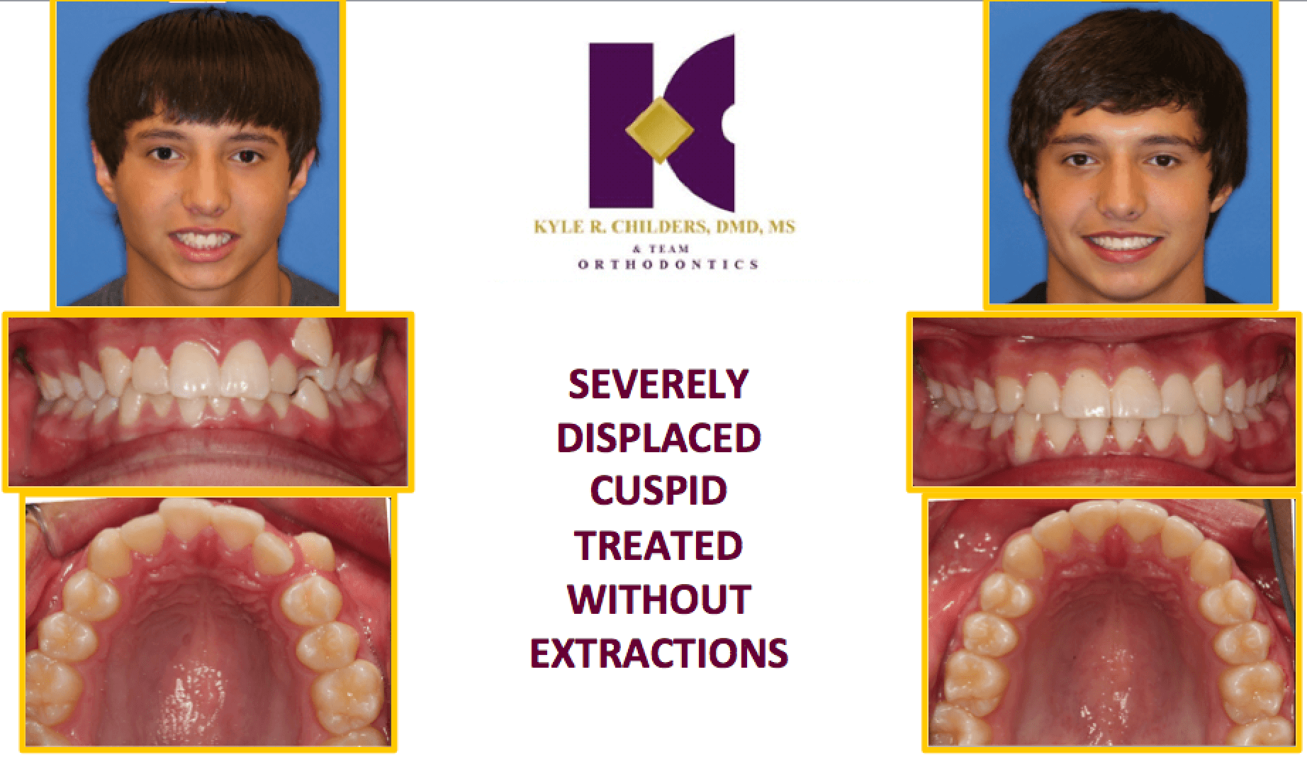 A picture of a boy 's teeth with the words 