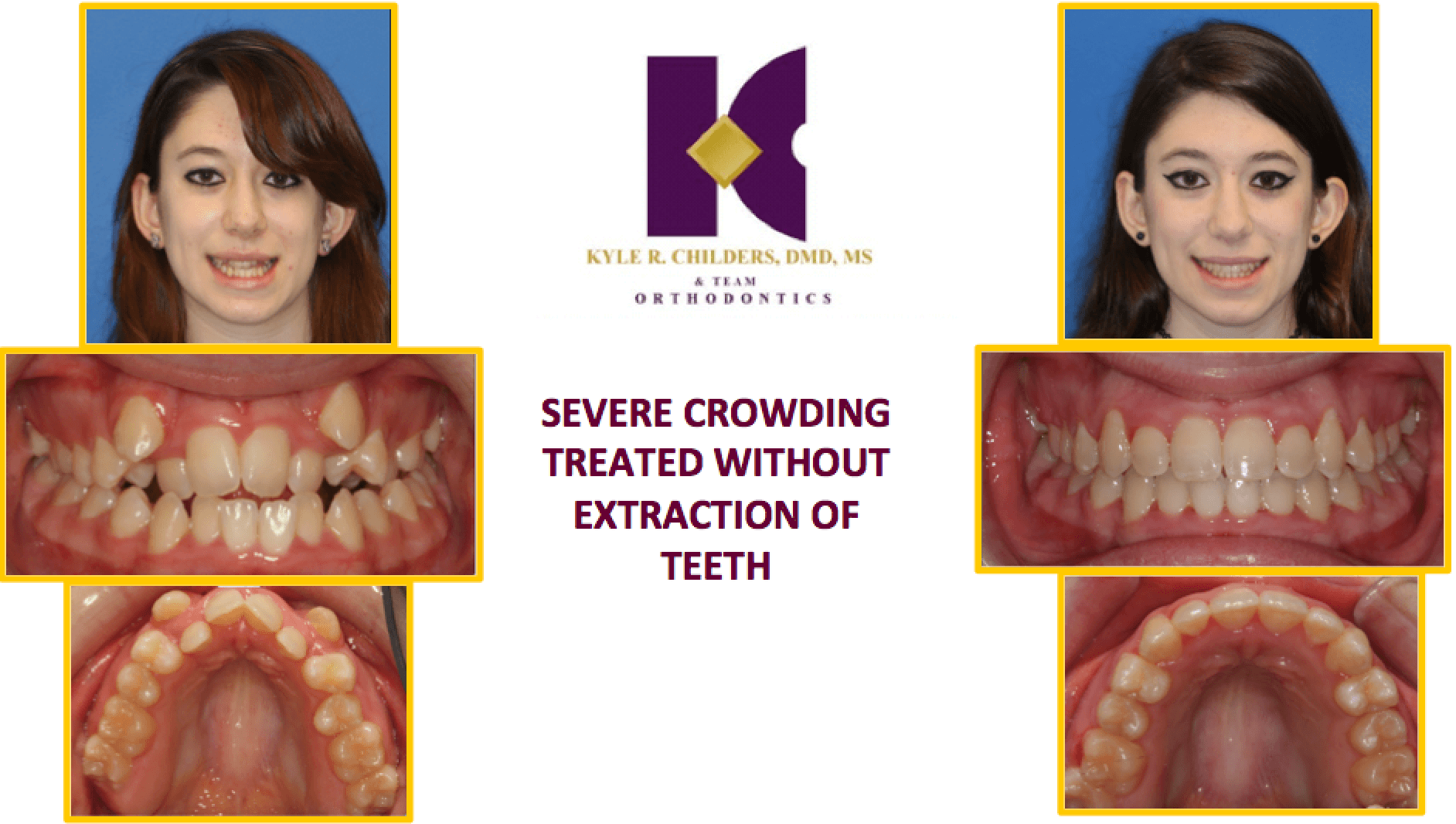A collage of pictures of a woman 's teeth with the words severe crowding treated without extraction of teeth