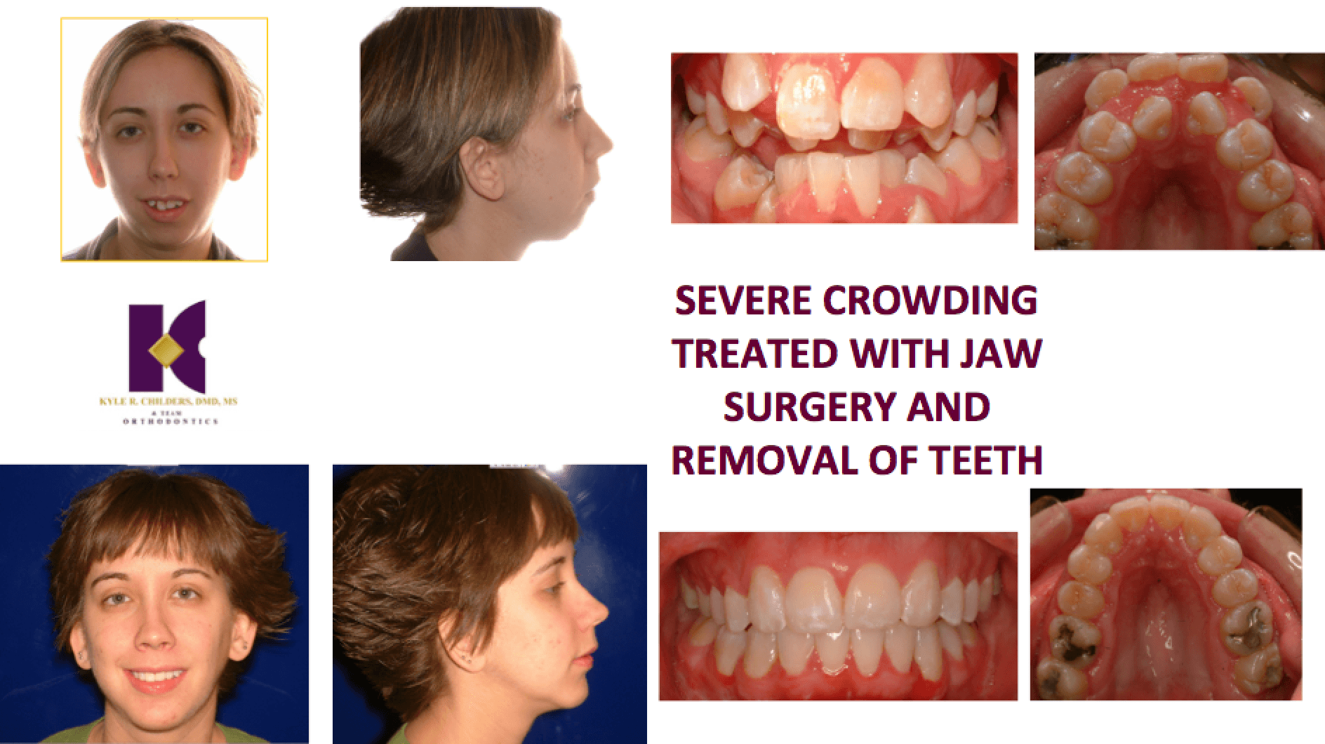 A woman with severe crowding treated with jaw surgery and removal of teeth
