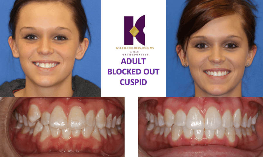 A before and after picture of a woman 's teeth with the words adult blocked out cuspid