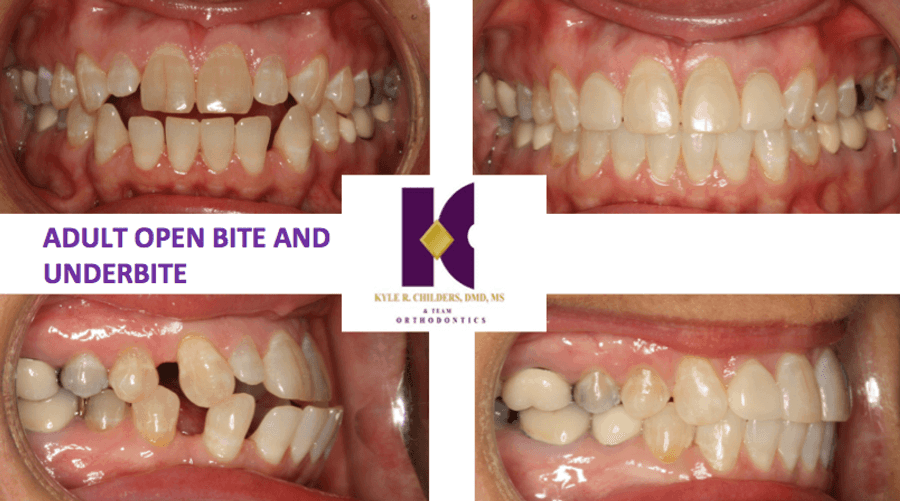 A picture of a person 's teeth with the words adult open bite and underbite