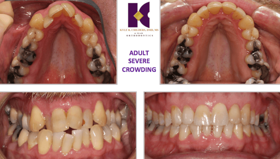 A close up of a person 's teeth with the words adult severe crowding on the bottom
