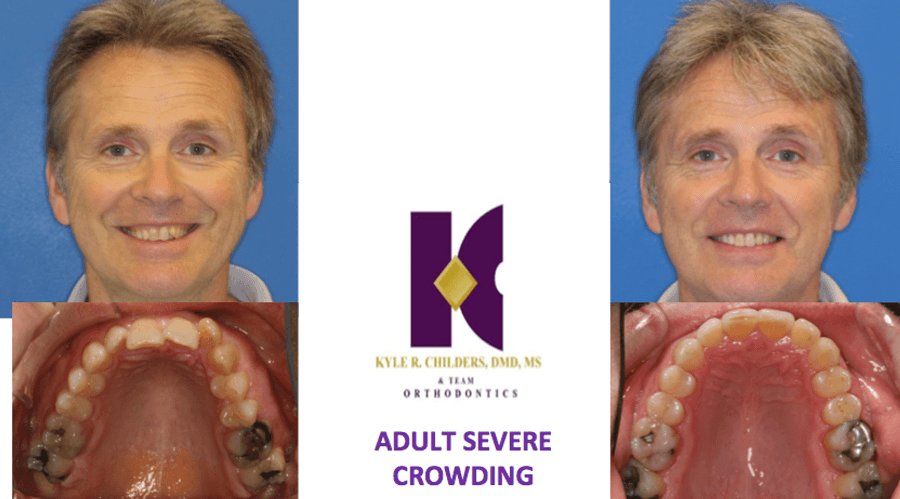 A man with severe crowding is smiling and holding his mouth open.