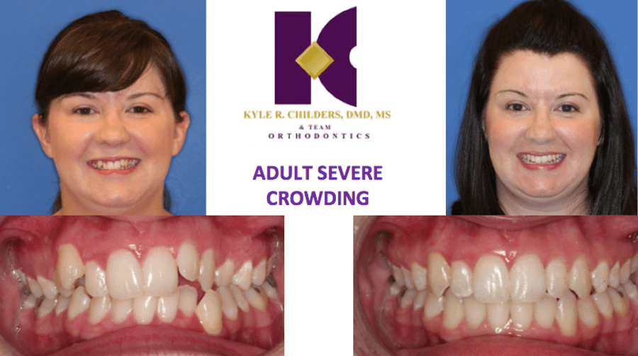 A before and after photo of a woman with severe crowding