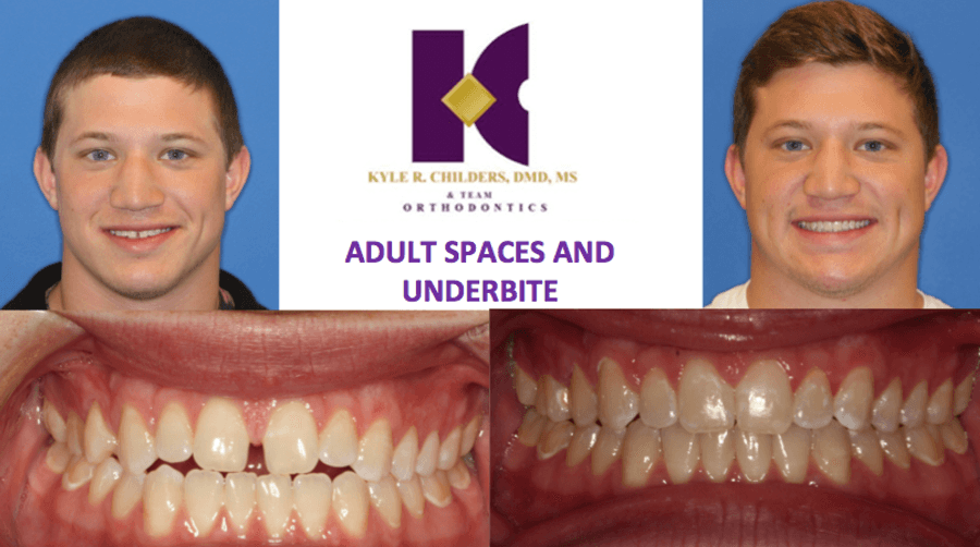 A picture of a man 's teeth before and after treatment for adult spaces and underbite