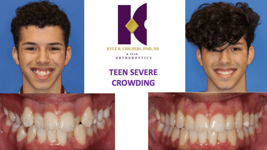 Two pictures of a young man with the words teen severe crowding on the bottom