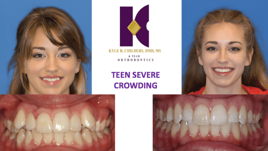 A picture of a girl 's teeth before and after crowding