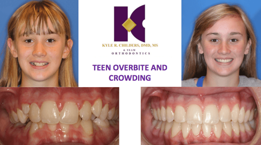 A picture of a girl 's teeth before and after braces