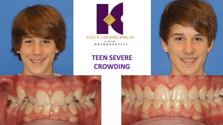 Two pictures of a boy with severe crowding on his teeth
