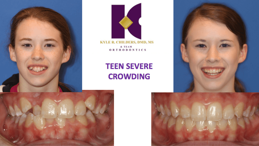 A picture of a girl 's teeth with the caption teen severe crowding