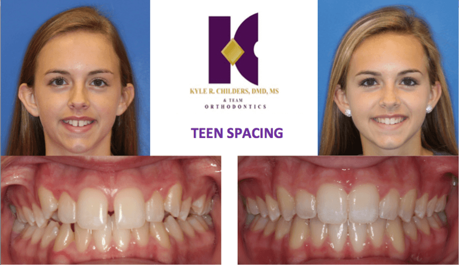 A picture of a girl 's teeth before and after teen spacing