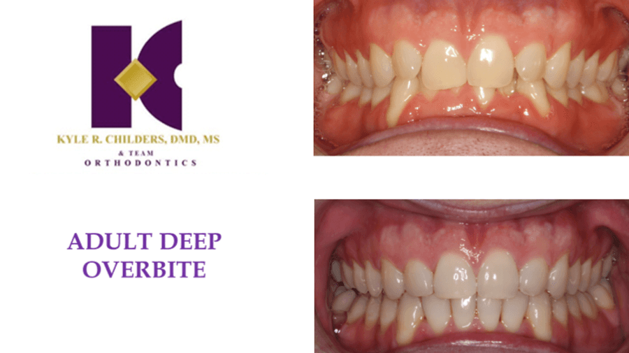A before and after picture of an adult deep overbite