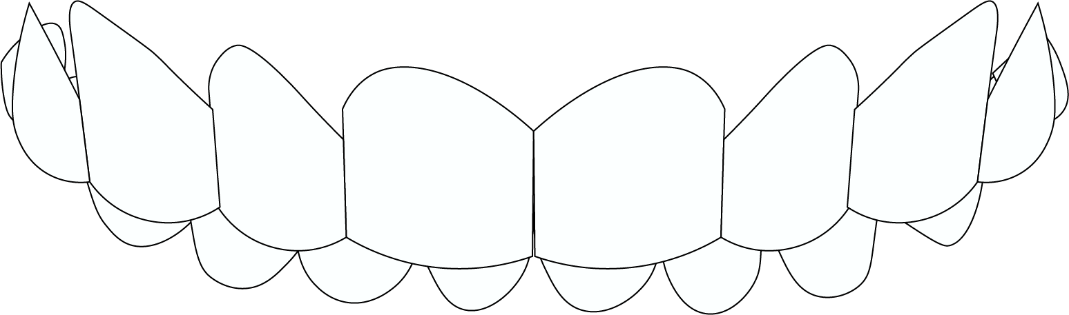 Overbite