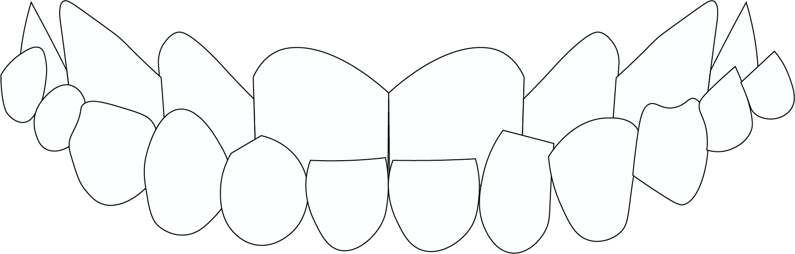 Underbite