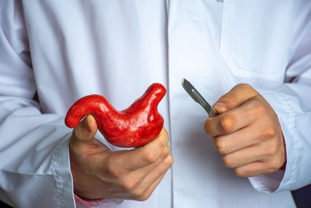 A Doctor Is Holding A Model Of A Stomach With A Scalpel — Brisbane Upper GI Surgery in Chermside, QLD