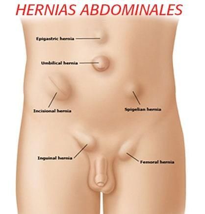 Diagrama de las hernias abdominales en español.