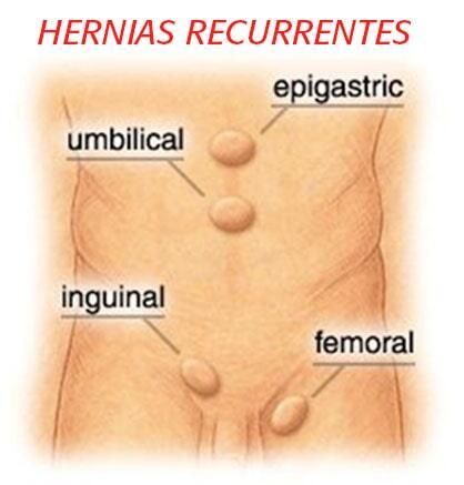 Un dibujo del estómago de una persona con las palabras hernias recurrentes en él.