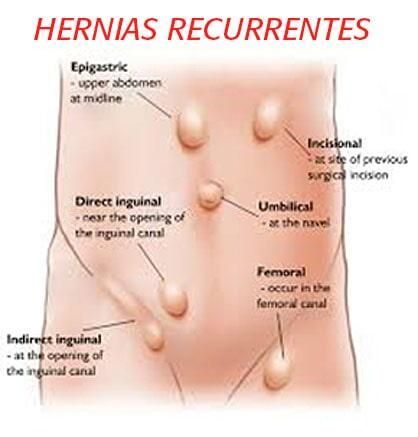 Un diagrama de hernias recurrentes en el estómago de una persona.