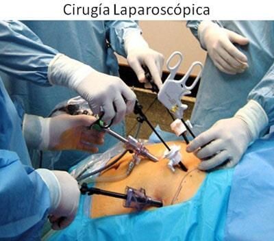 Un grupo de cirujanos está realizando una cirugía laparoscópica a un paciente.