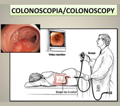 Diagrama de una colonoscopia realizada a un paciente.