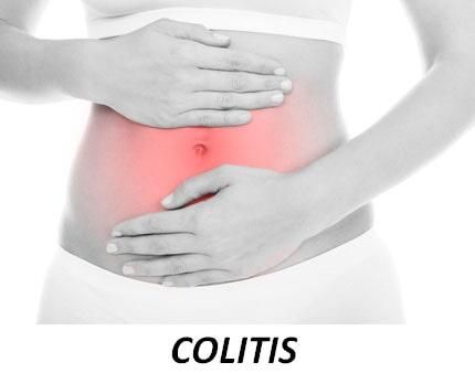 Una mujer se sostiene el estómago por dolor debido a una colitis.