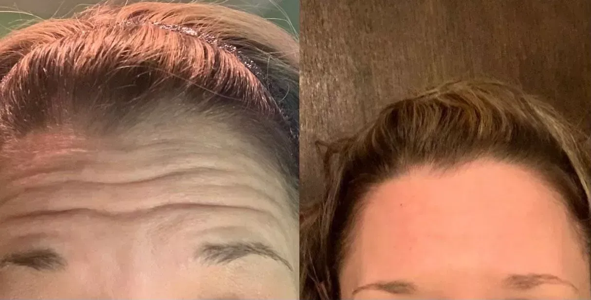 Before And After Botox Treatment – Rhinebeck, NY – La Lume Med Spa