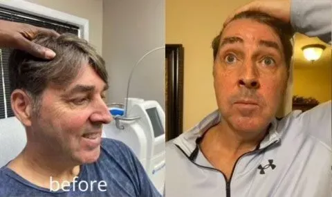 Men's Botox Treatment – Rhinebeck, NY – La Lume Med Spa