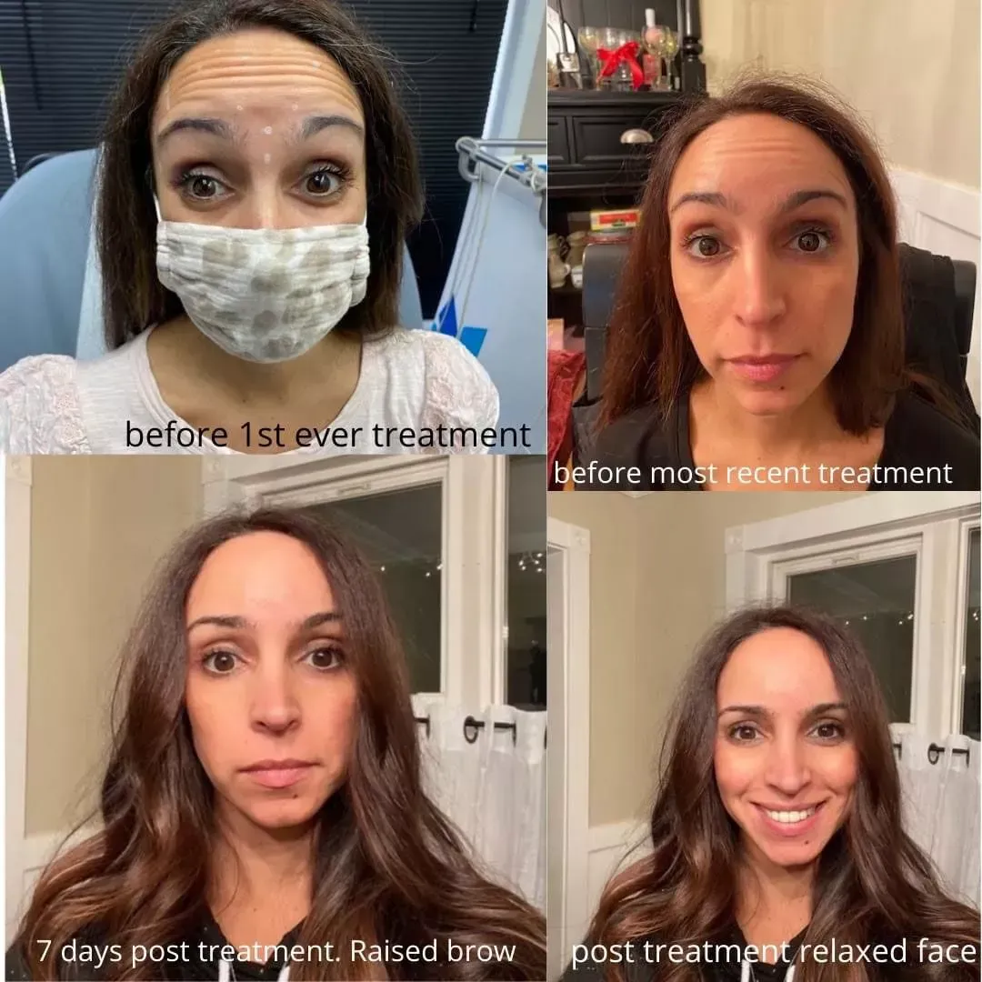 Botox Treatment – Rhinebeck, NY – La Lume Med Spa