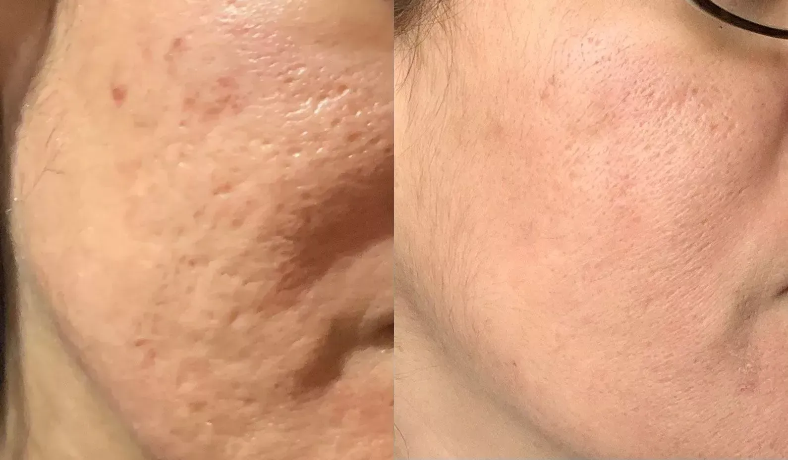 Before And After Microneedling – Rhinebeck, NY – La Lume Med Spa