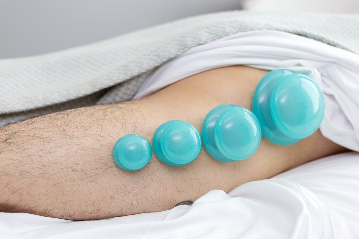 A man is laying on a bed with cupping cups on his leg.