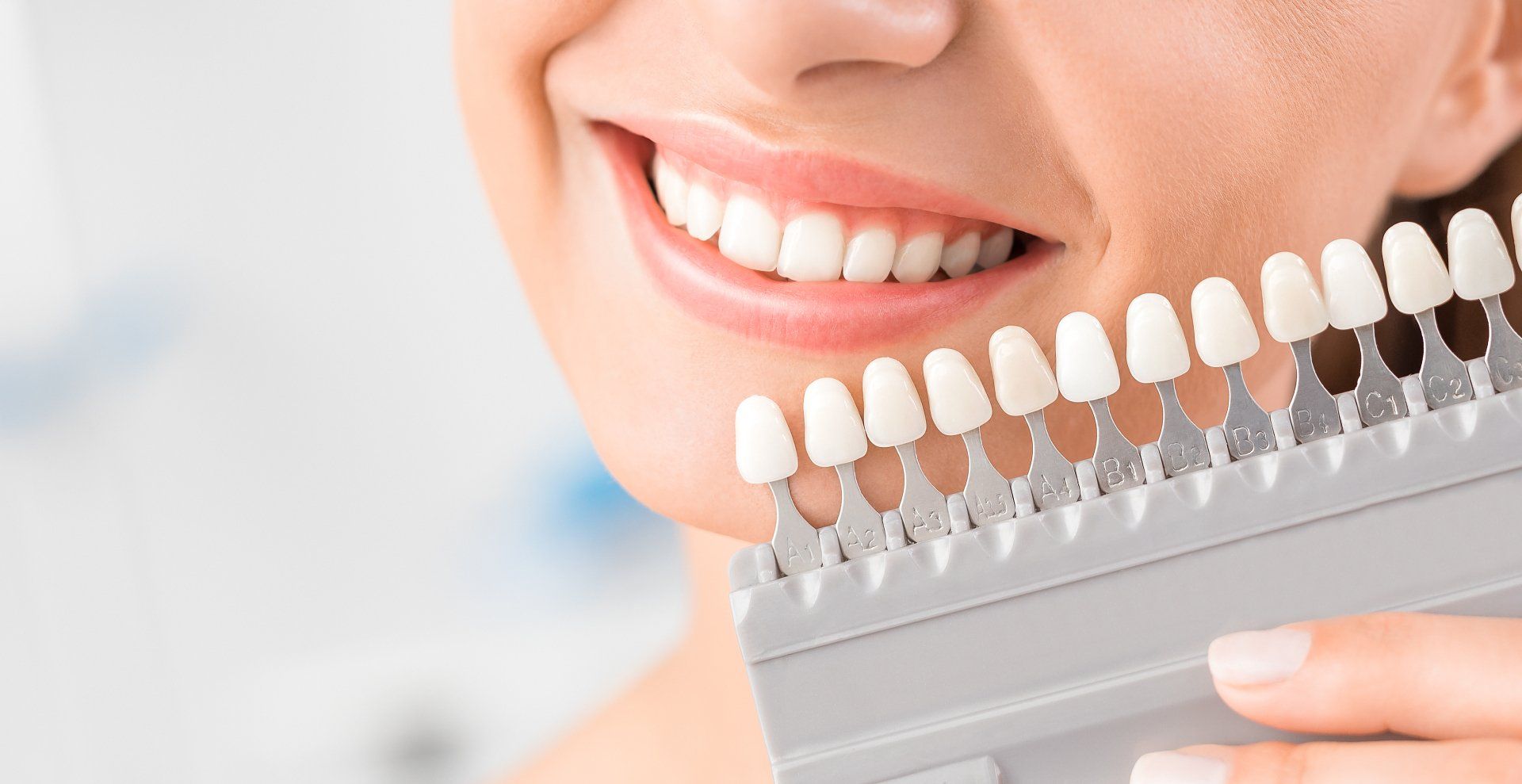 faccette dentali