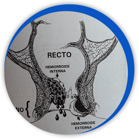 DR. BERNARDO GUTIÉRREZ CUEVAS - Prolapso rectal DR. BERNARDO GUTIÉRREZ CUEVAS - Prolapso rectal