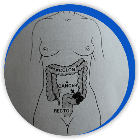DR. BERNARDO GUTIÉRREZ CUEVAS - Abscesos y fistulas anos rectales DR. BERNARDO GUTIÉRREZ CUEVAS - Abscesos y fistulas anos rectales