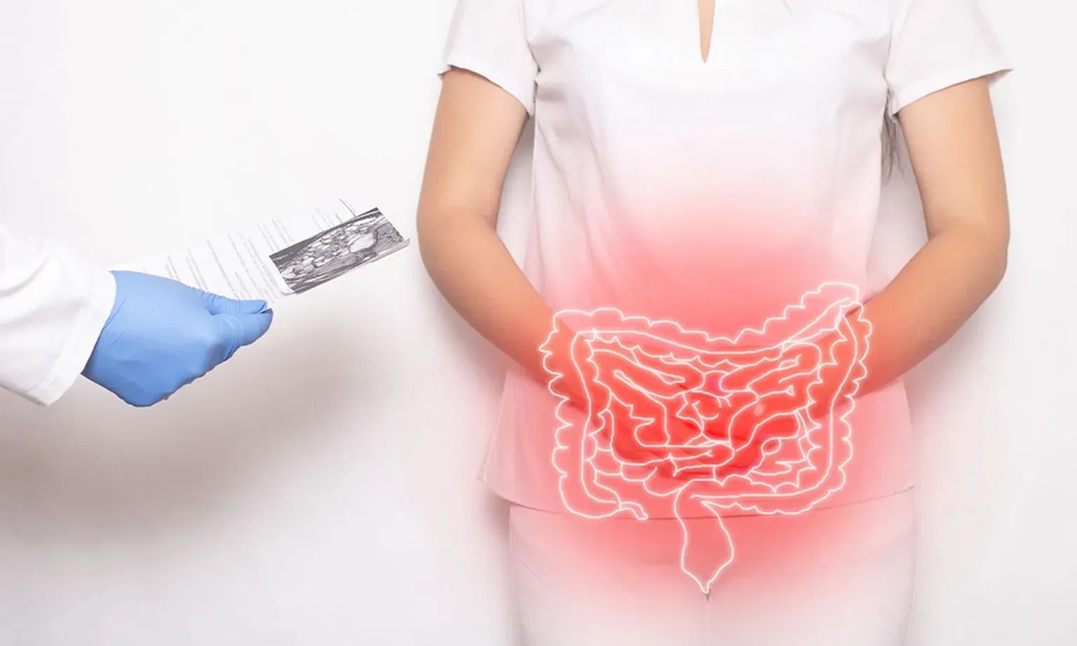 Diverticulosis