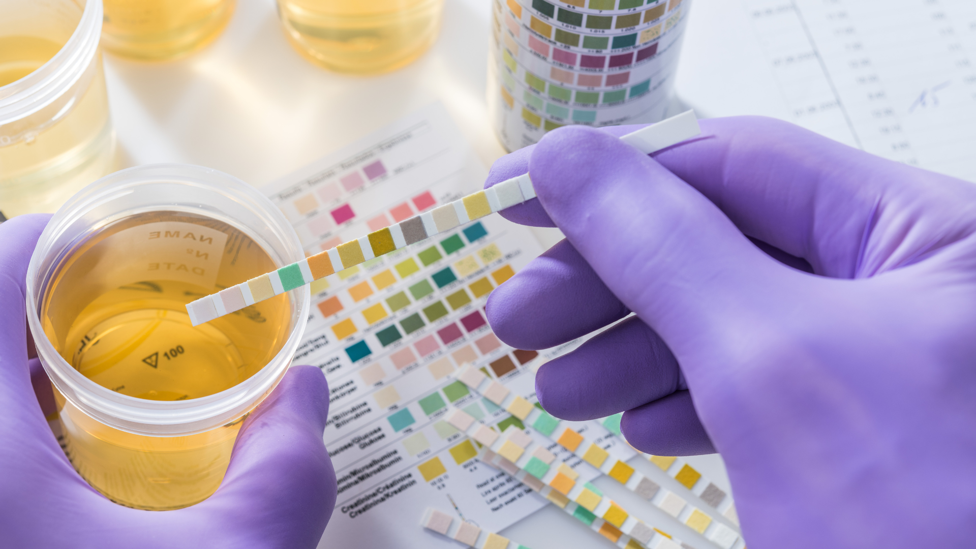 A gloved hand dips a multi-test urine reagent strip into a specimen cup against a background of diagnostic color charts.