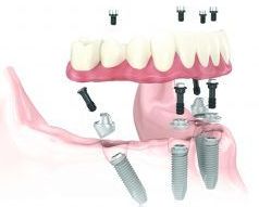 Dental Implants