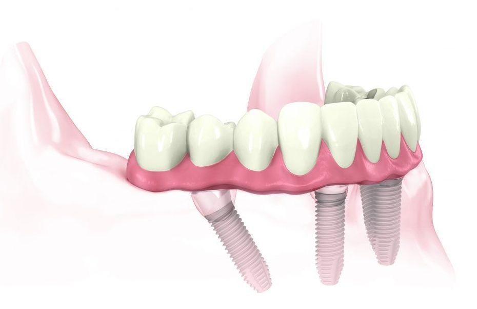 Dental Implants