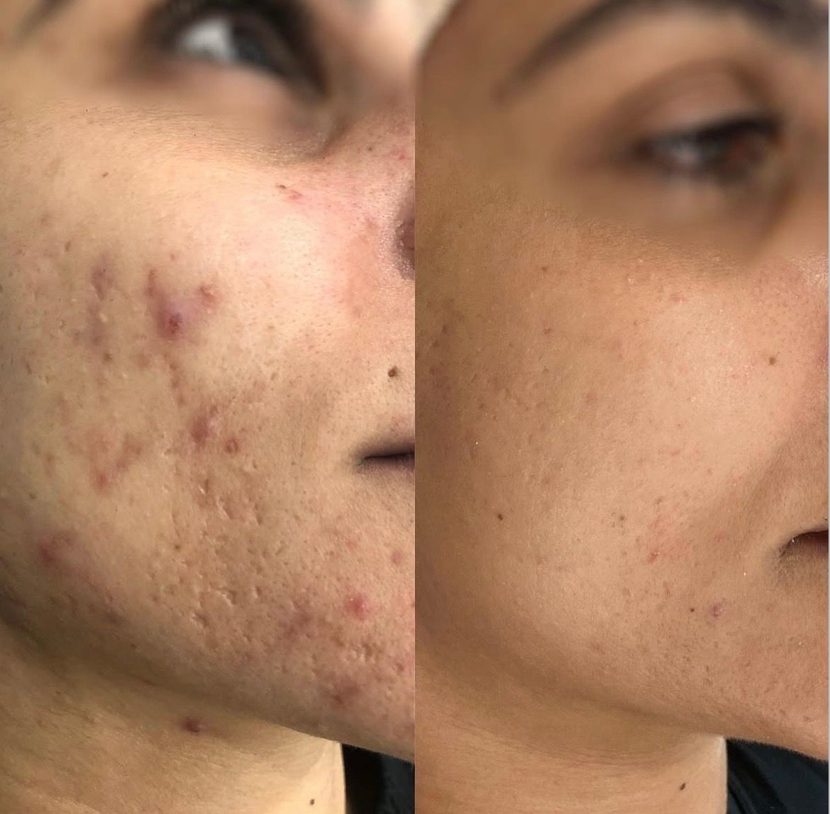 Before and after acne scarring and redness improvement, Aesthetic Artistry Skin Wollongong