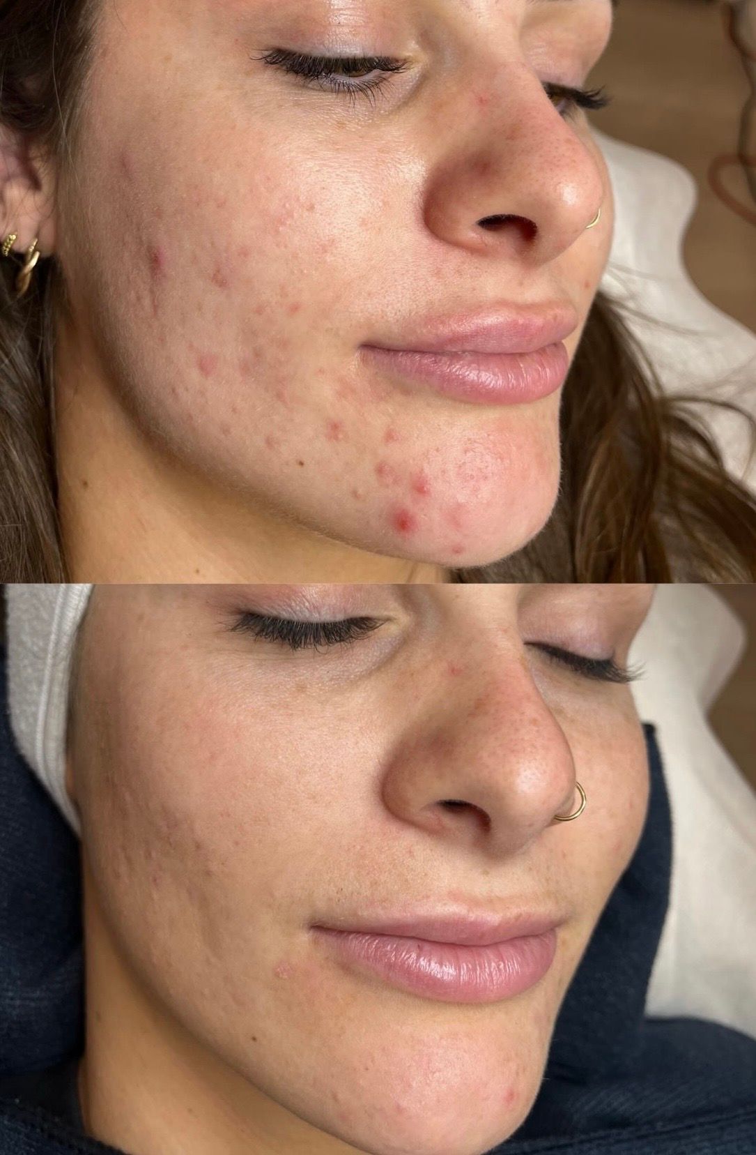 Before and after active acne clearing on the cheek, Aesthetic Artistry Skin Wollongong