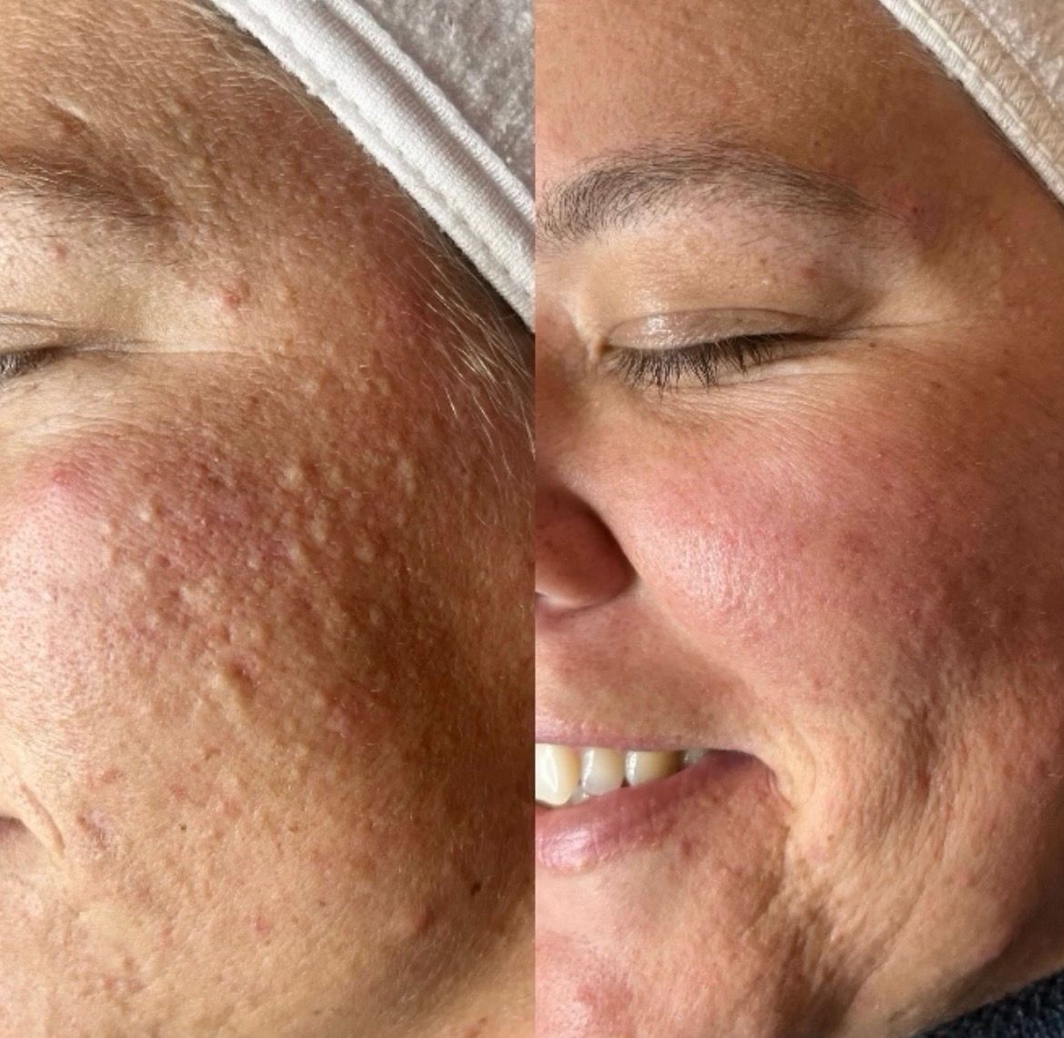 Before and after acne scarring and skin texture improvement, Aesthetic Artistry Skin Wollongong