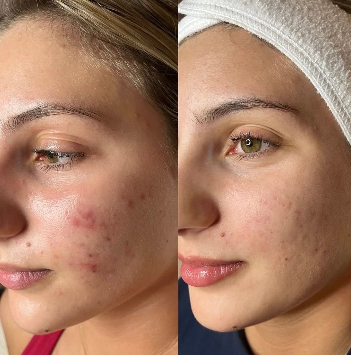 Before and after acne and redness clearing on the cheek, Aesthetic Artistry Skin Wollongong