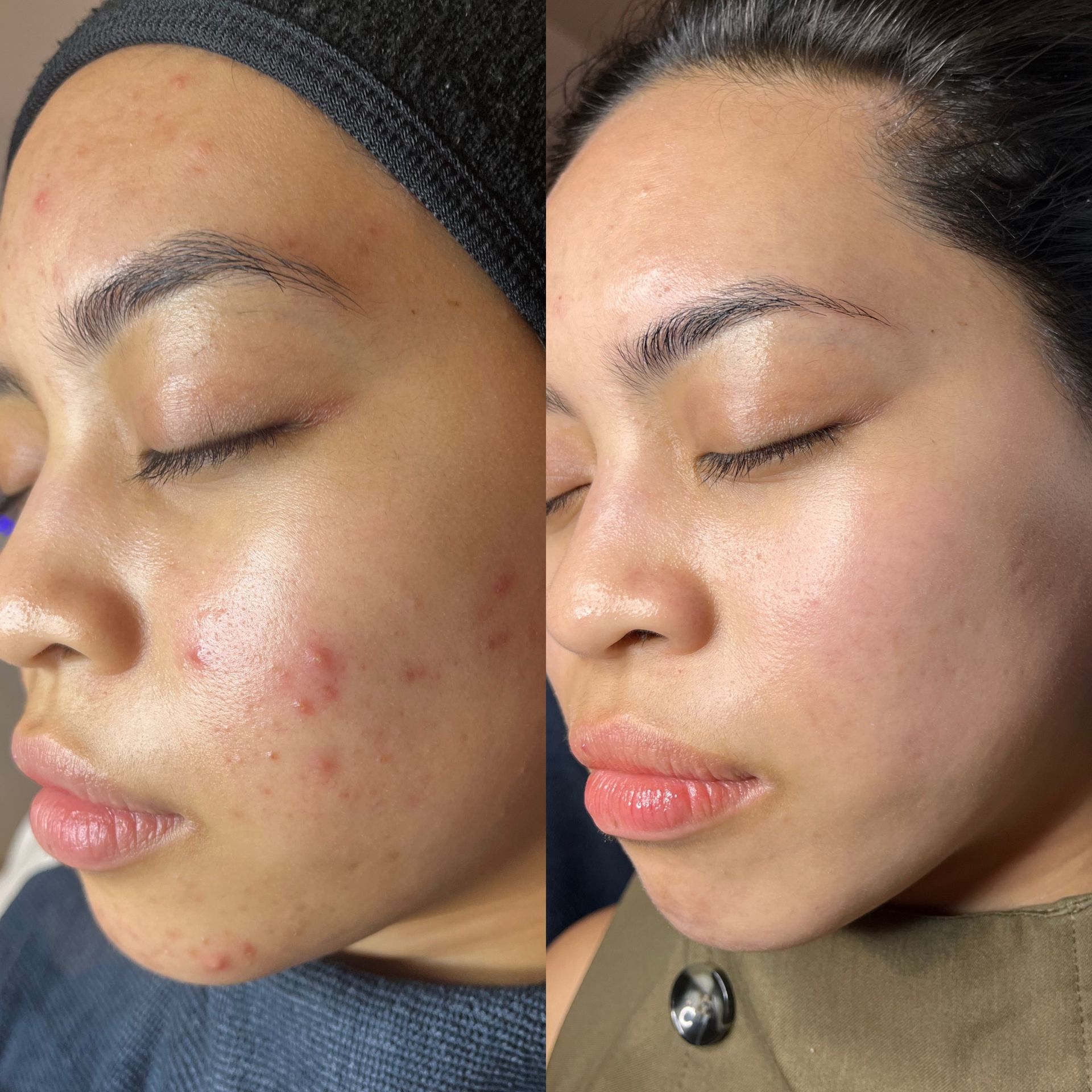 Before and after acne and inflammation improvement, Aesthetic Artistry Skin Wollongong