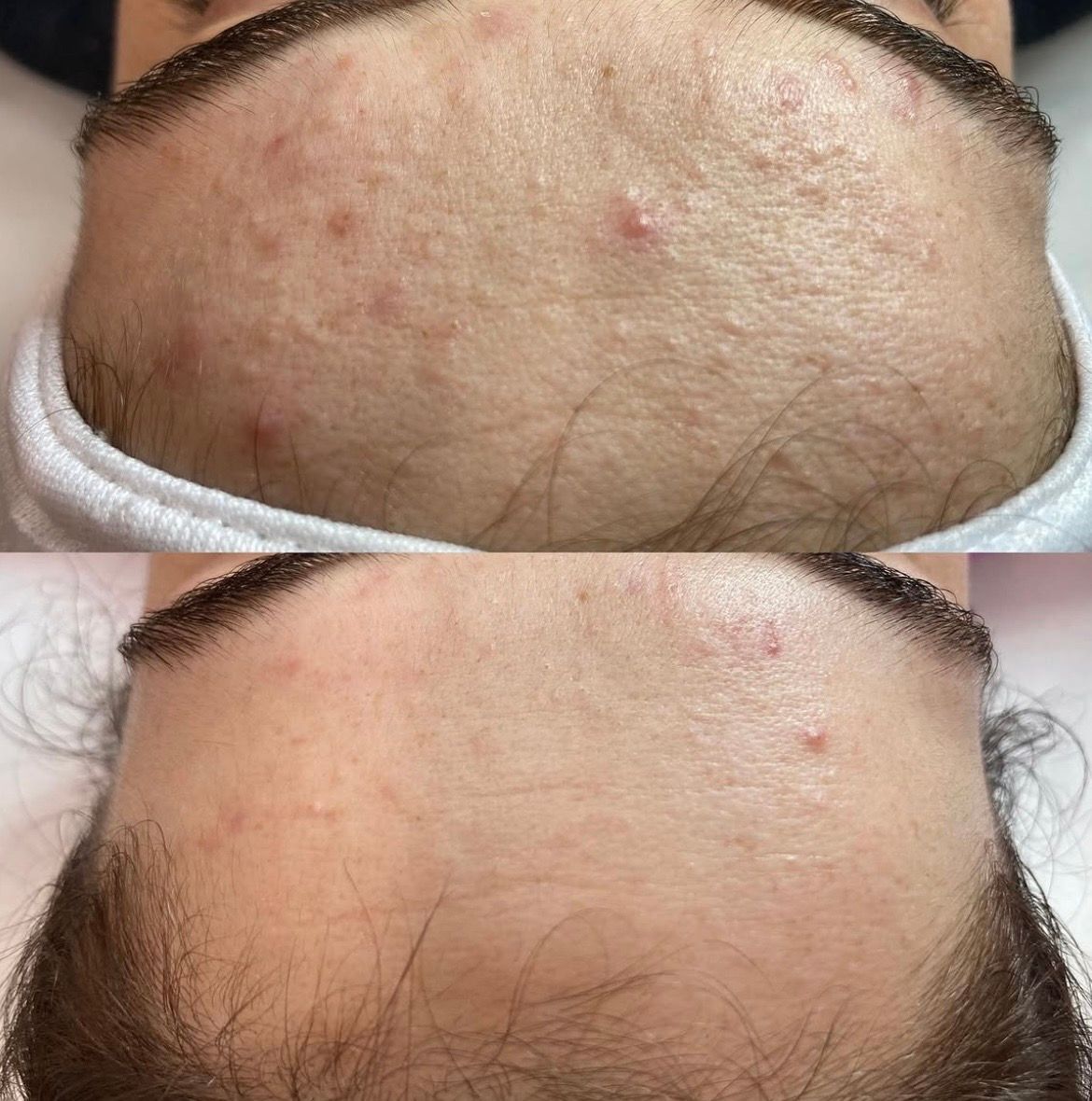 Before and after forehead congestion and breakout improvement, Aesthetic Artistry Skin Wollongong