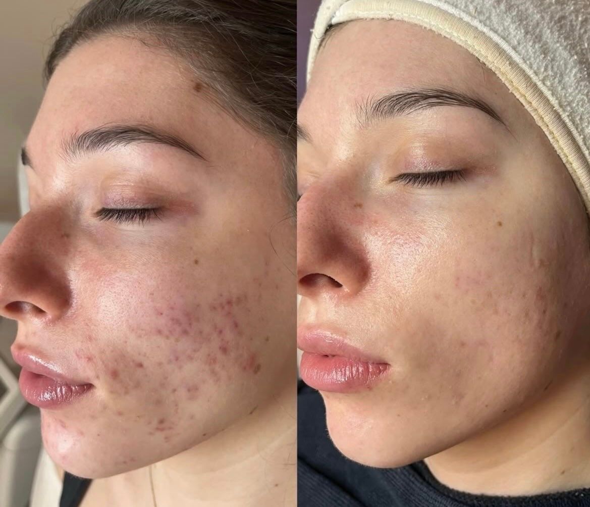 Before and after acne and post-inflammatory redness improvement, Aesthetic Artistry Skin Wollongong