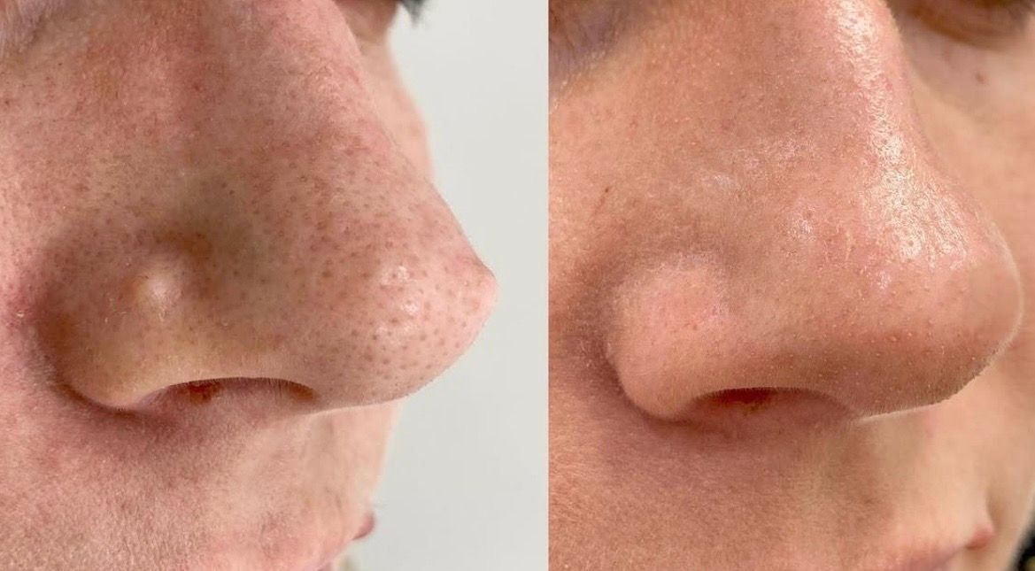 Before and after congested pores and blackhead improvement on the nose, Aesthetic Artistry Skin Wollongong
