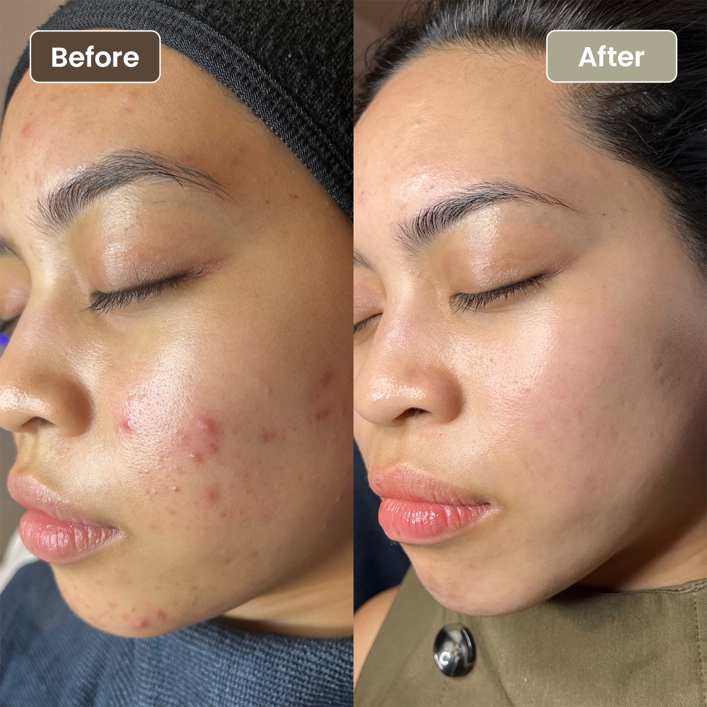 Before and after acne and inflammation improvement, Aesthetic Artistry Skin Wollongong